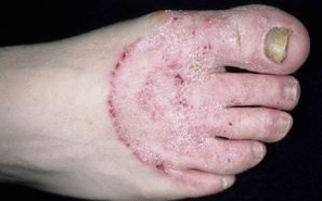 Les raisons de l'apparence du champignon sur les jambes