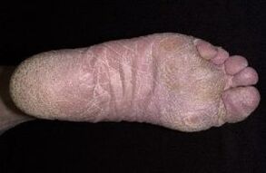 Signes et symptômes de champignons sur les jambes