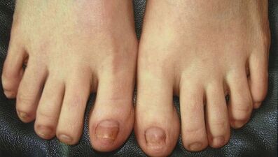 Phases de développement des champignons de l'ongle