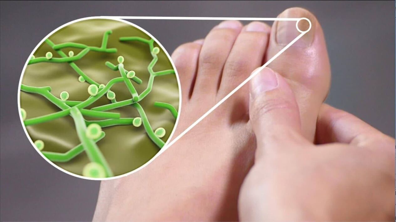 Agent pathogène du champignon de l'ongle du pied