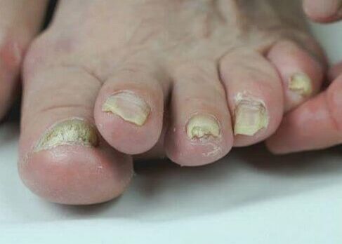 Traiter la mycose des ongles avec des médicaments