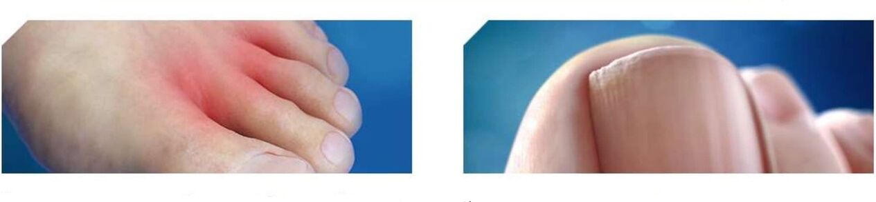 Stade initial du pied d'athlète