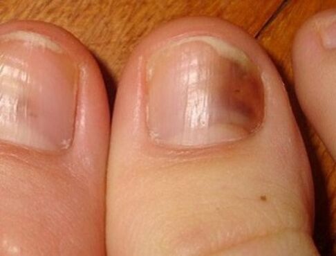 Symptômes de la mycose des ongles des pieds